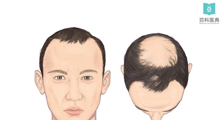 探究导致脱发的8个原因（了解引发脱发的因素及预防方法）