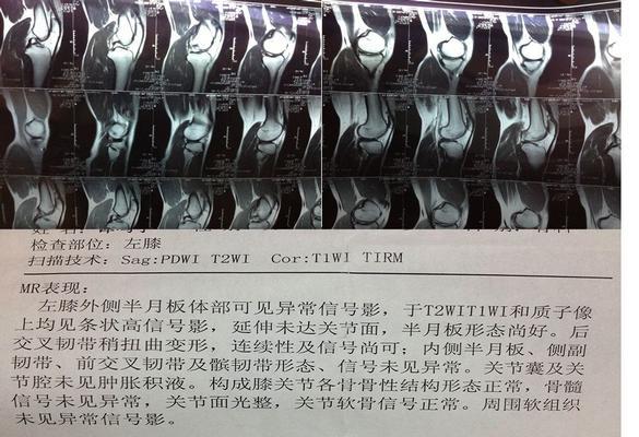 半月板损伤自测（通过自测了解半月板损伤风险）