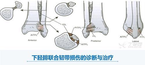 韧带拉伤的正确处理方式（预防与康复的关键措施）